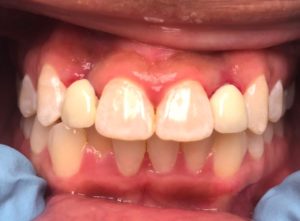 After Home Dr. Regan Ackerman. Freedom Mini Dental Implants.Mini Dental Implants in Louisville Kentucky 40272 Home Dr. Regan Ackerman. Freedom Mini Dental Implants.Mini Dental Implants in Louisville Kentucky 40272