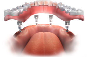 dentures louisville Dr. Regan Ackerman. Freedom Mini Dental Implants.Mini Dental Implants in Louisville Kentucky 40272
