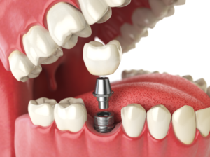 dental implant illustration dental implants vs mini dental implants Dr. Regan Ackerman. Freedom Mini Dental Implants.Mini Dental Implants in Louisville Kentucky 40272