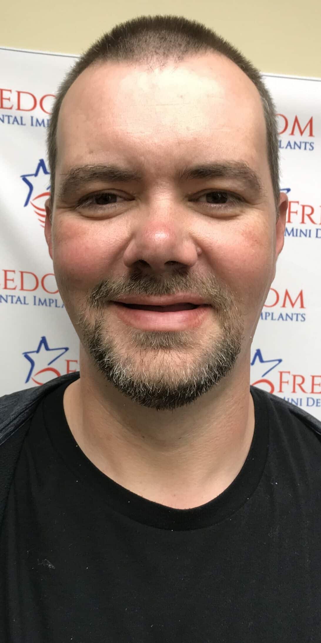 Home Dr. Regan Ackerman. Freedom Mini Dental Implants. Mini Dental Implants in Louisville Kentucky 40291