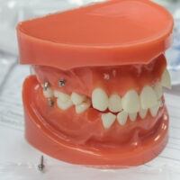 Dental Implants vs. Mini Dental Implants Dr. Regan Ackerman. Freedom Mini Dental Implants. Mini Dental Implants in Louisville Kentucky 40272
