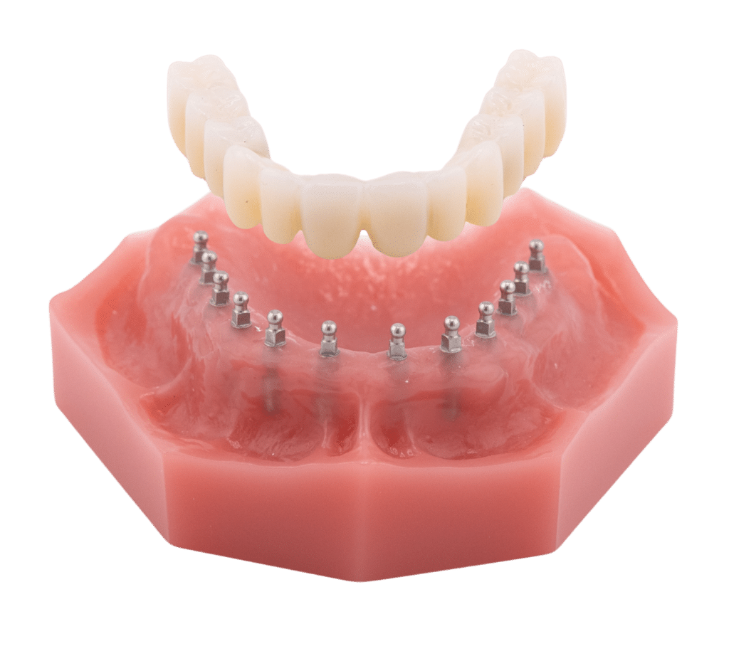 Illustration of a full-arch dental bridge positioned above supporting implants