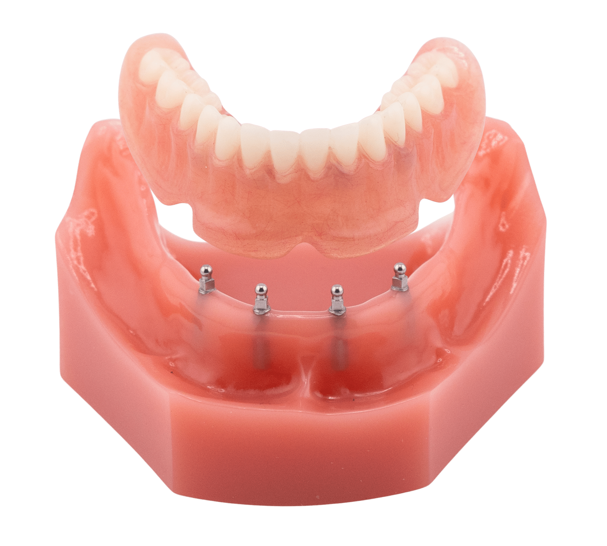 Snap-On Denture