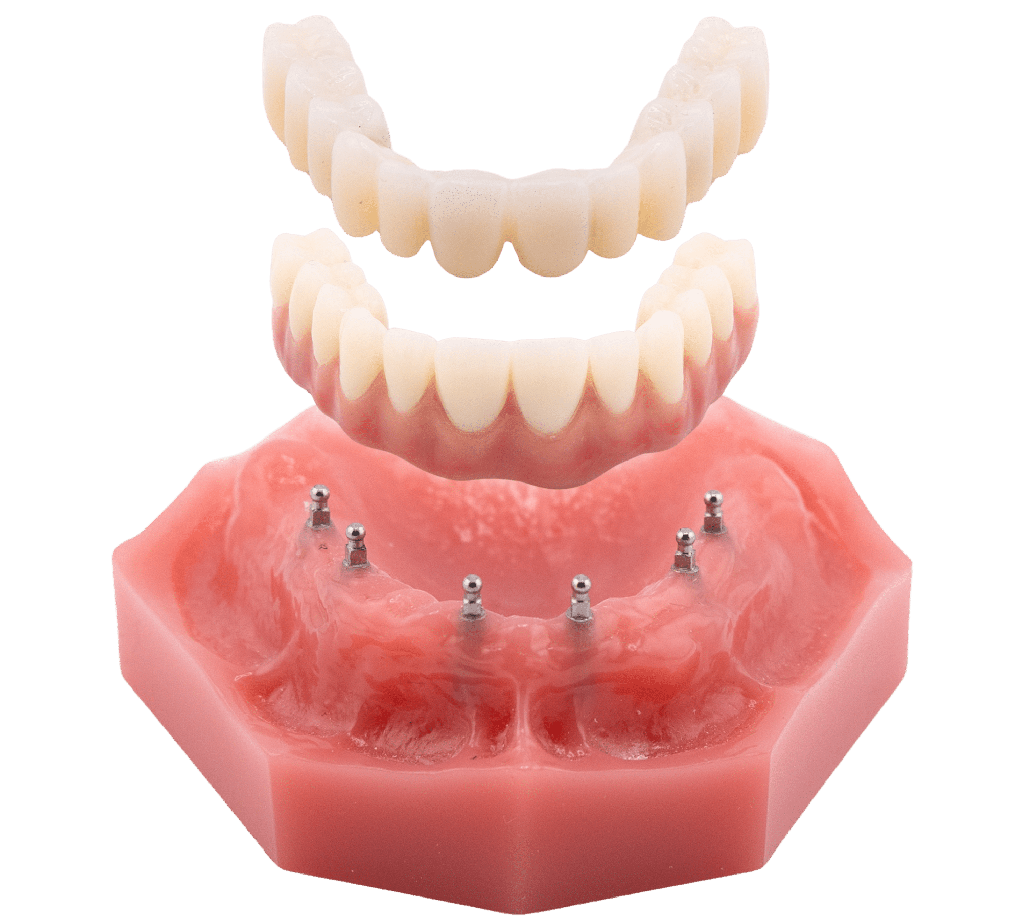 Illustration of fixed and detachable full-arch bridge options floating above dental implant supports