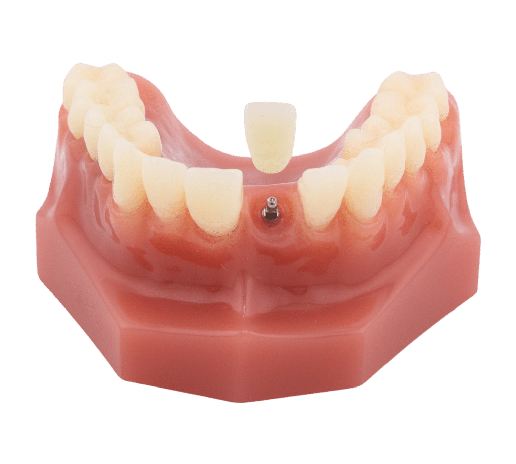 Illustration of a replacement crown positioned over a single dental implant