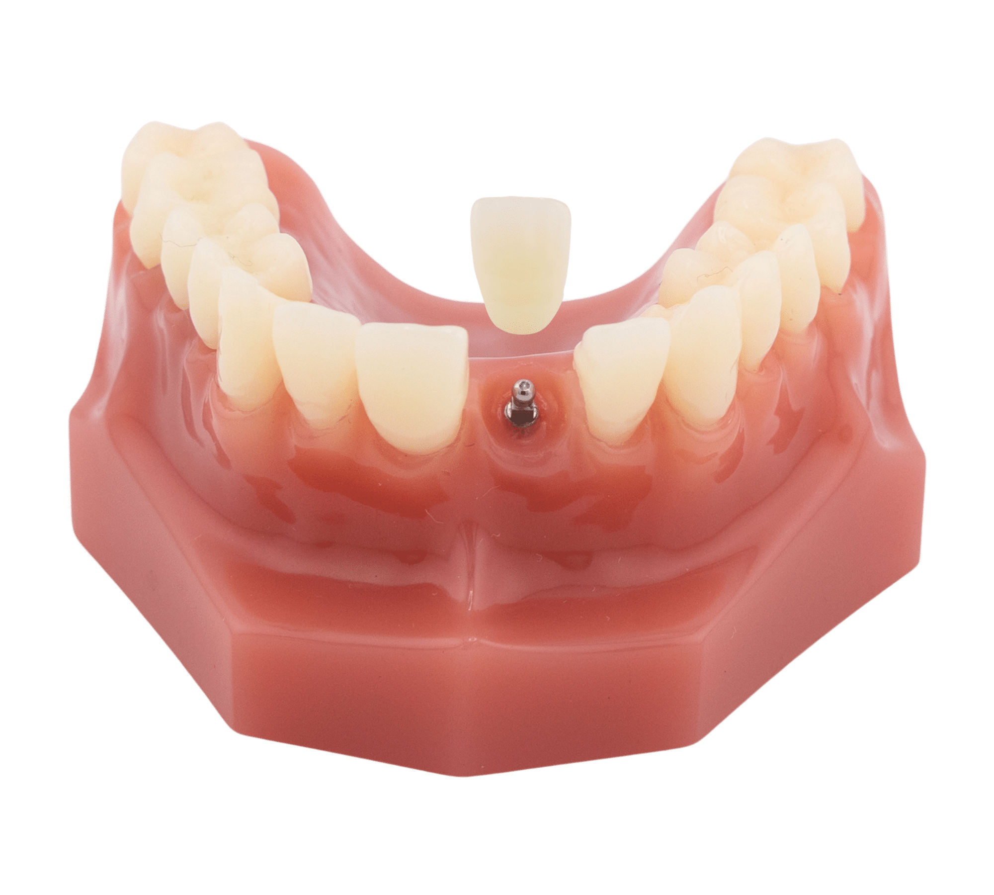 Illustration of a replacement crown positioned over a single dental implant