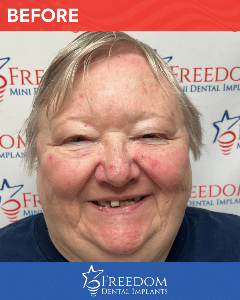 Before-treatment smile photo from Freedom Dental Implants in Louisville