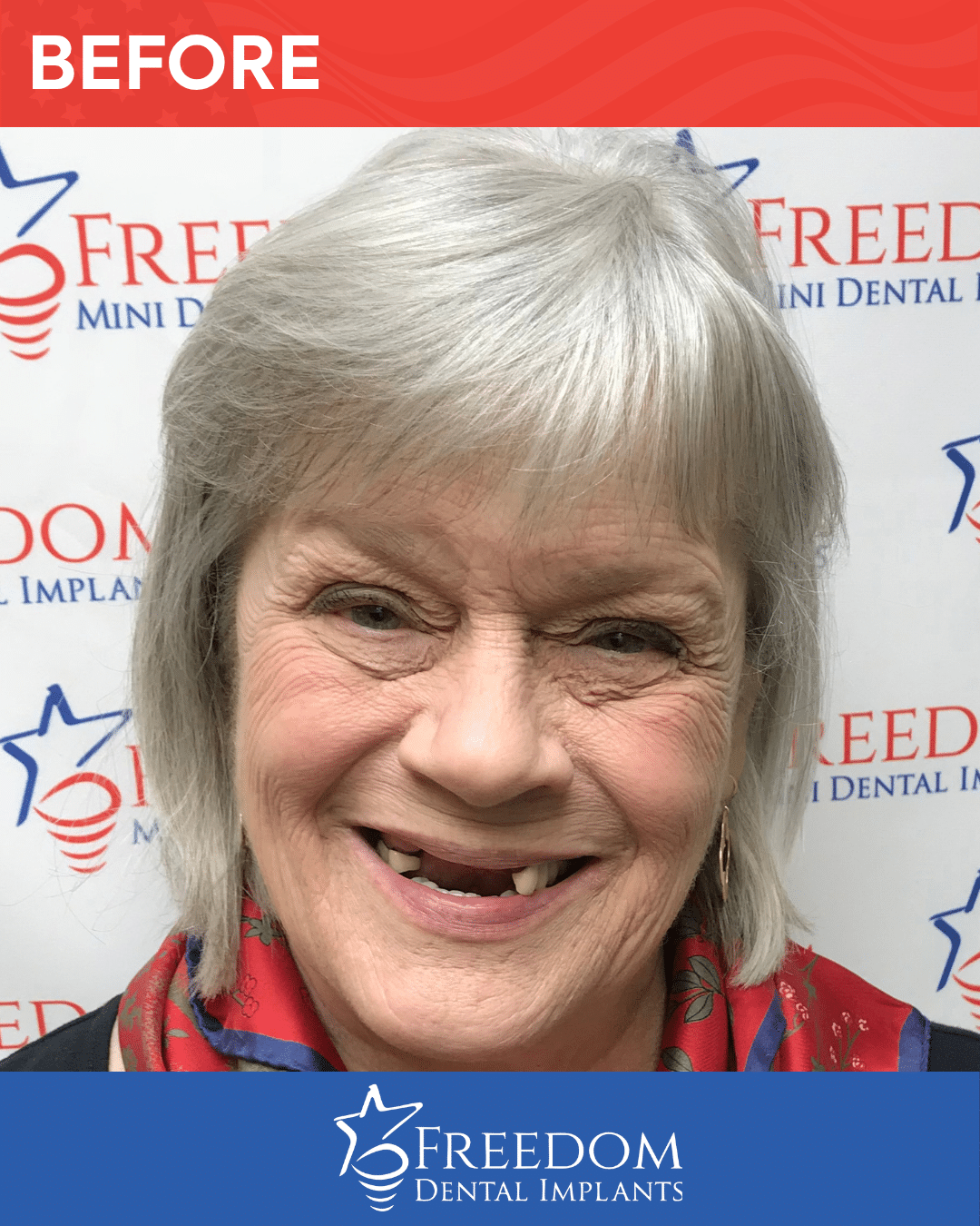 Before-treatment smile photo from Freedom Dental Implants in Louisville