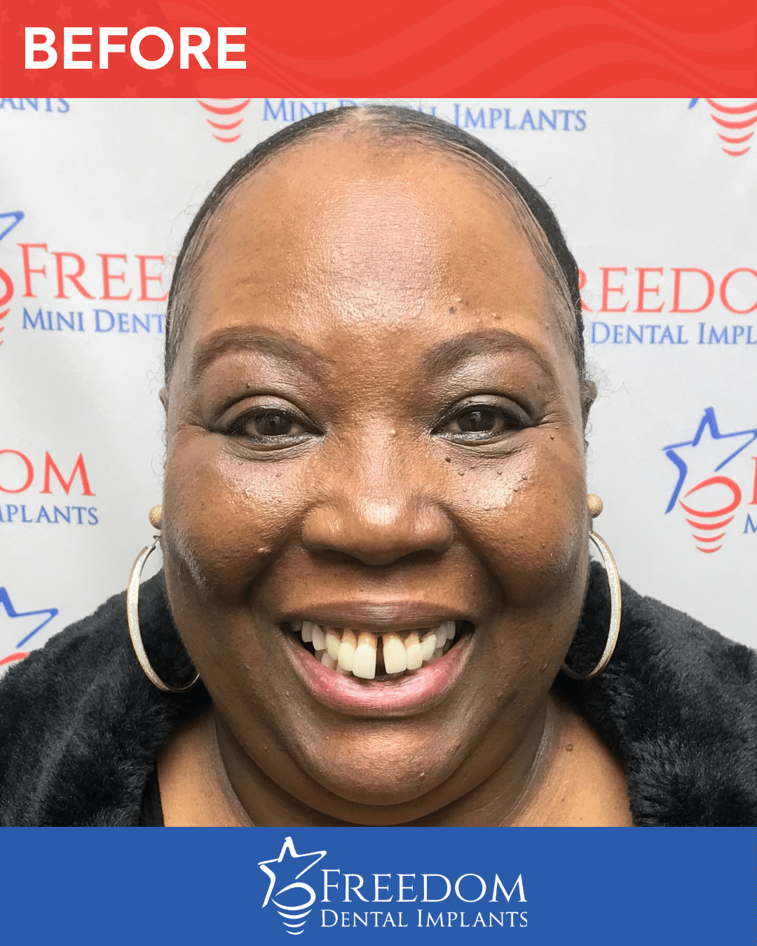 Before-treatment smile photo from Freedom Dental Implants in Louisville