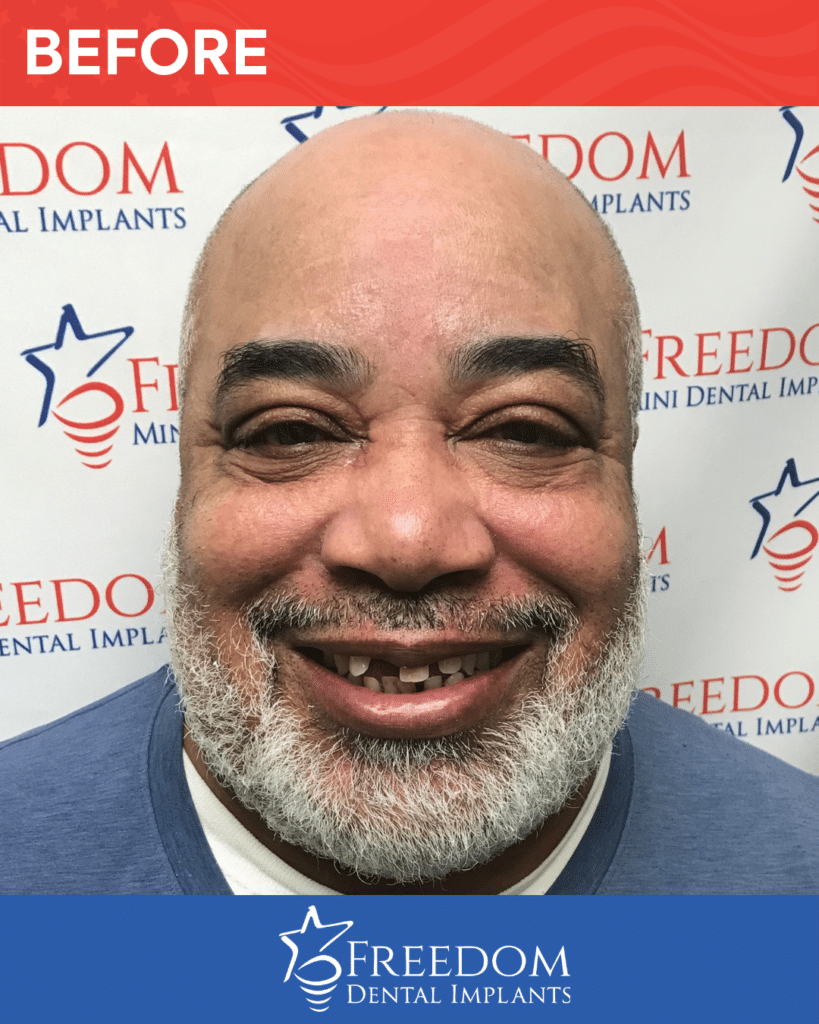 Before-treatment smile photo from Freedom Dental Implants in Louisville