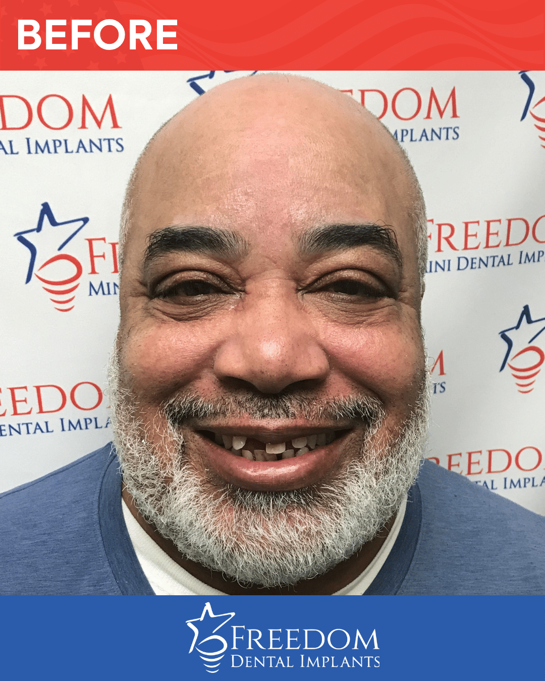 Before-treatment smile photo from Freedom Dental Implants in Louisville