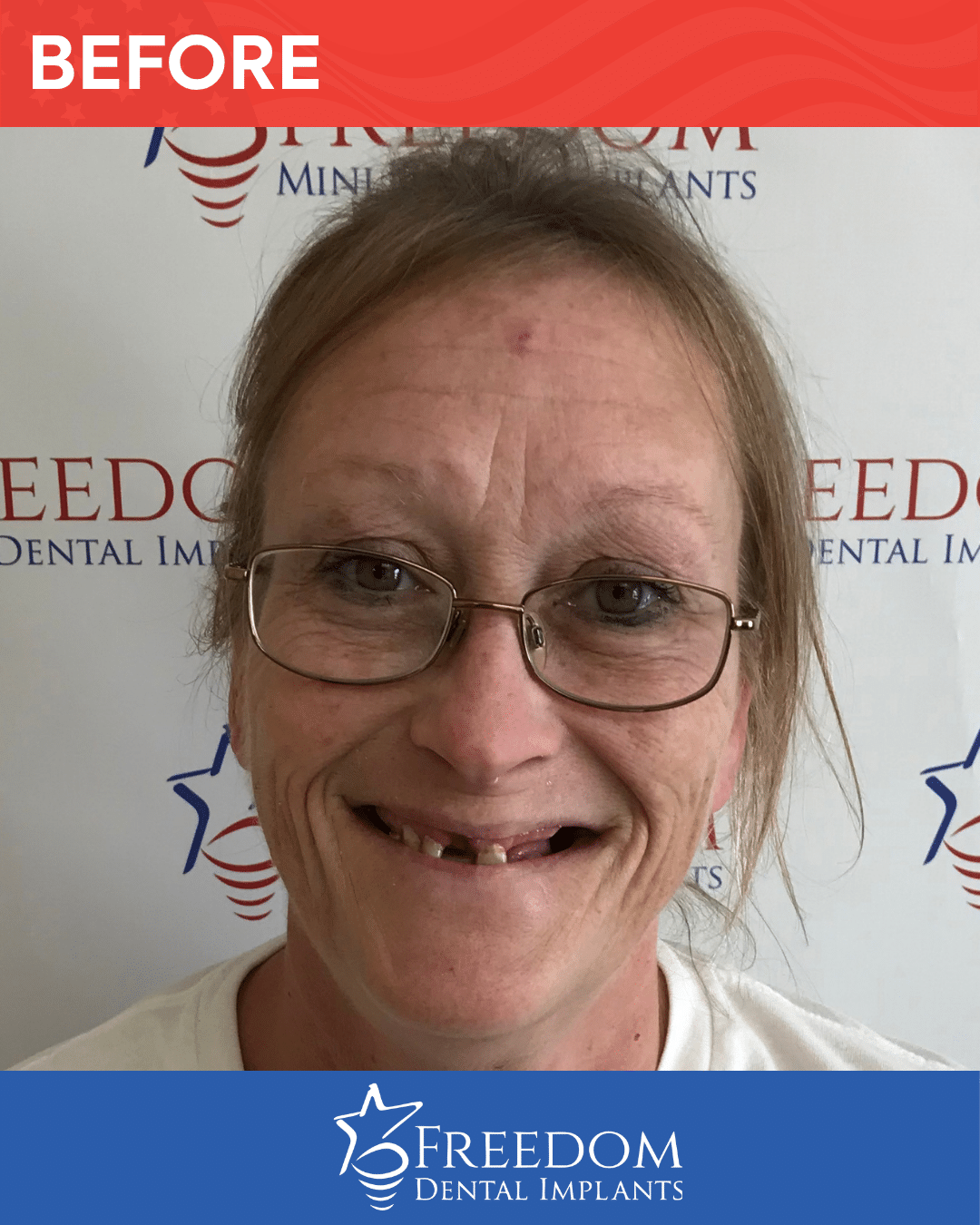 Before-treatment smile photo from Freedom Dental Implants in Louisville