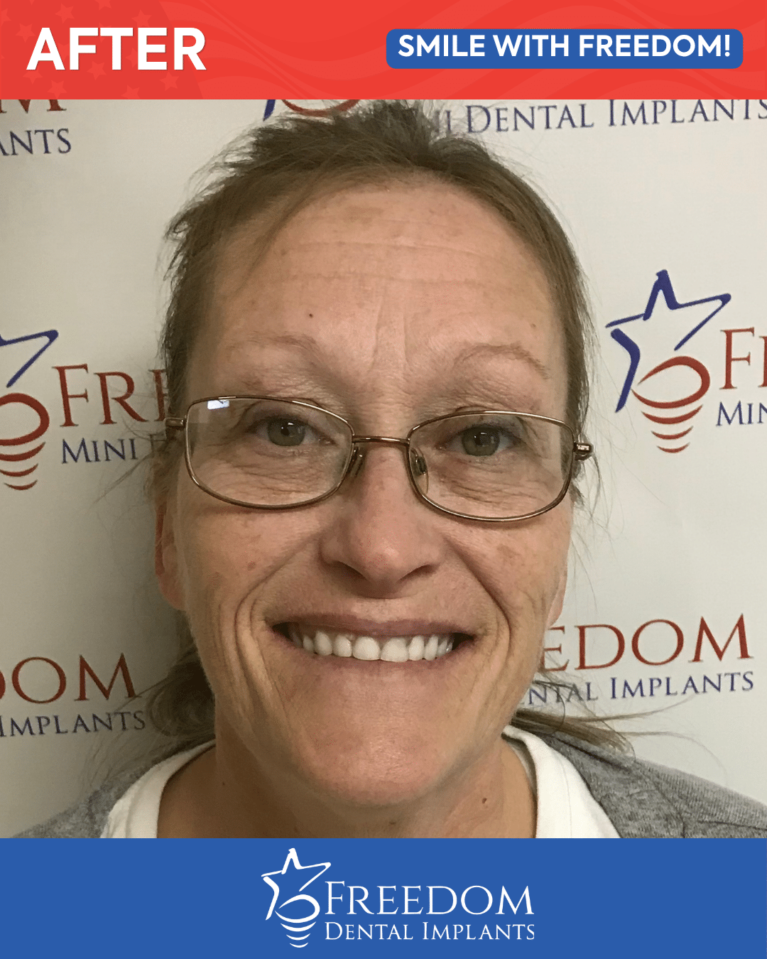 After-treatment smile photo from Freedom Dental Implants in Louisville