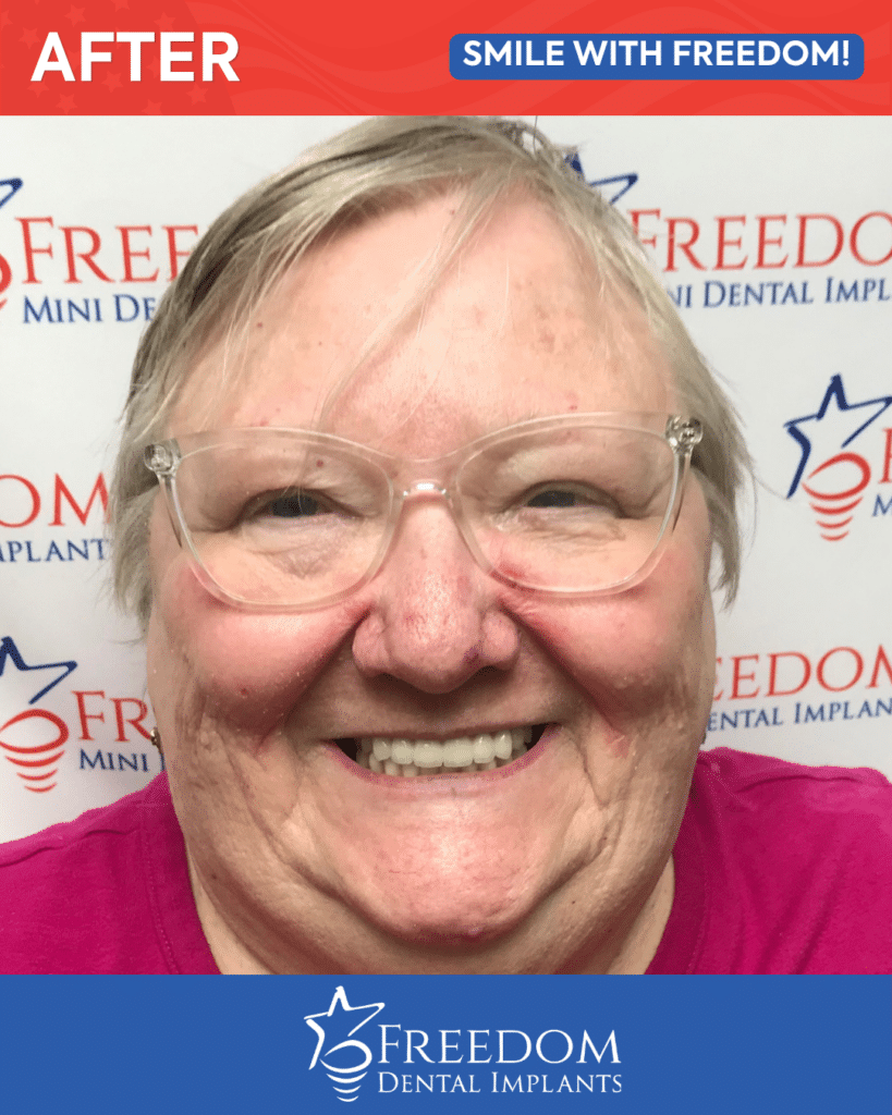 After-treatment smile photo from Freedom Dental Implants in Louisville