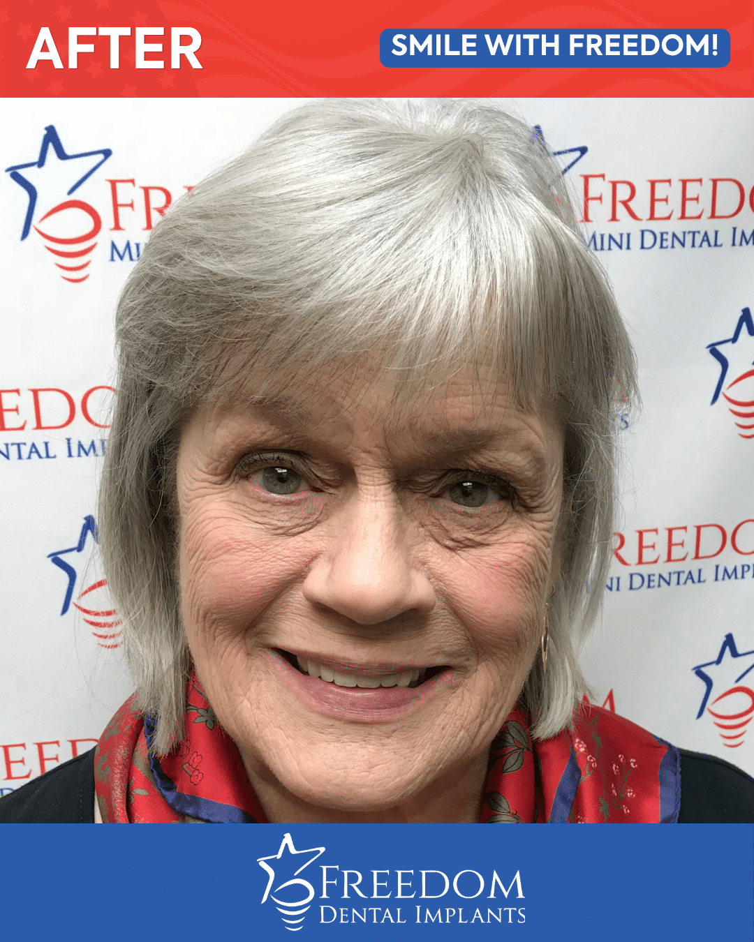 After-treatment smile photo from Freedom Dental Implants in Louisville