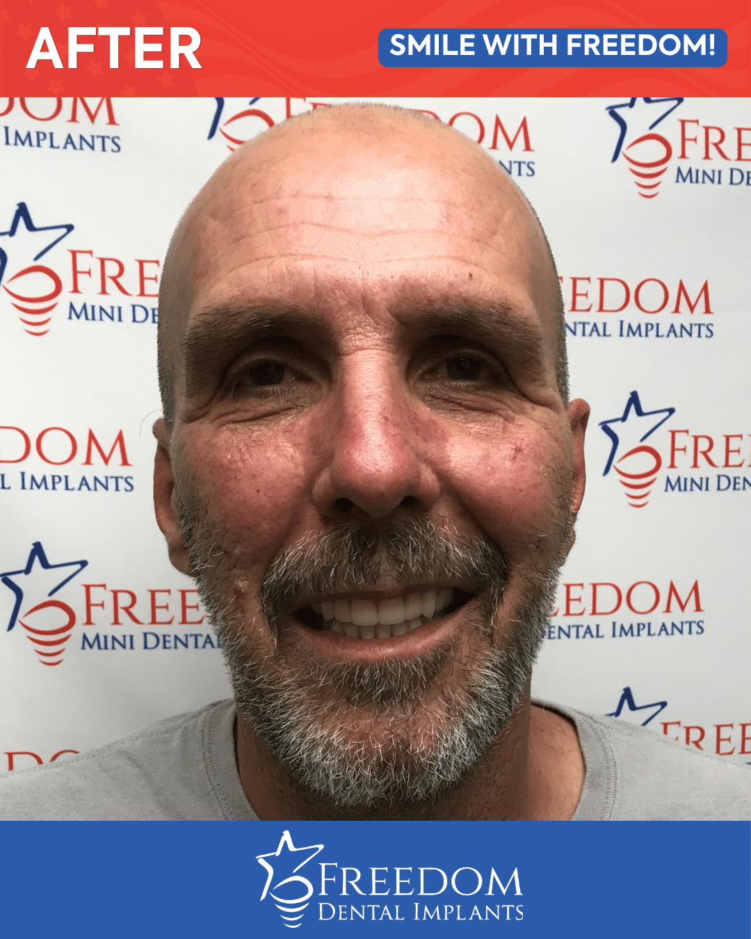 After-treatment smile photo from Freedom Dental Implants in Louisville