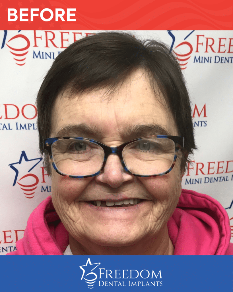 Before-treatment smile photo from Freedom Dental Implants in Louisville