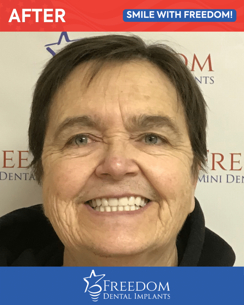 After-treatment smile photo from Freedom Dental Implants in Louisville