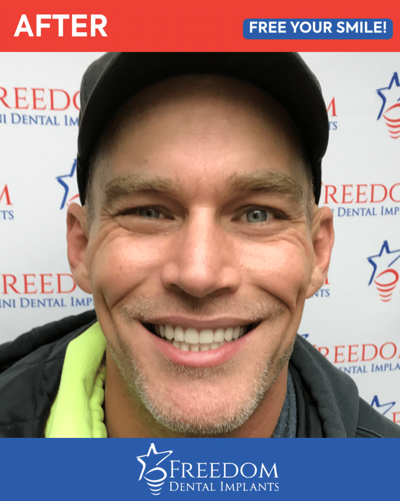 After-treatment smile photo from Freedom Dental Implants in Louisville