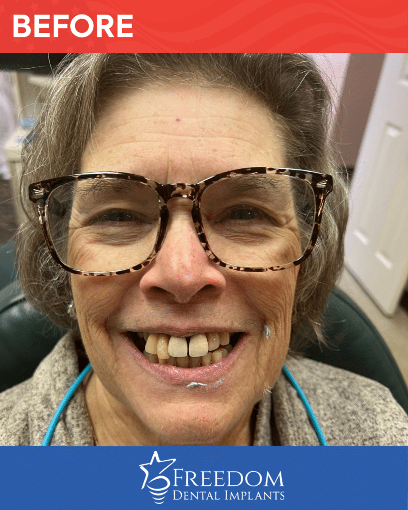 Before-treatment smile photo from Freedom Dental Implants in Louisville