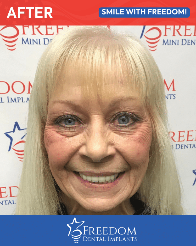 After-treatment smile photo from Freedom Dental Implants in Louisville