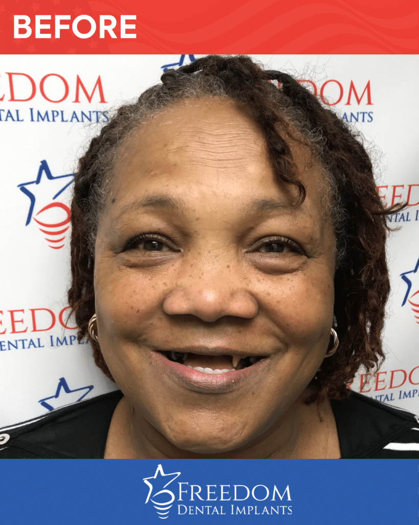 Before-treatment smile photo from Freedom Dental Implants in Louisville