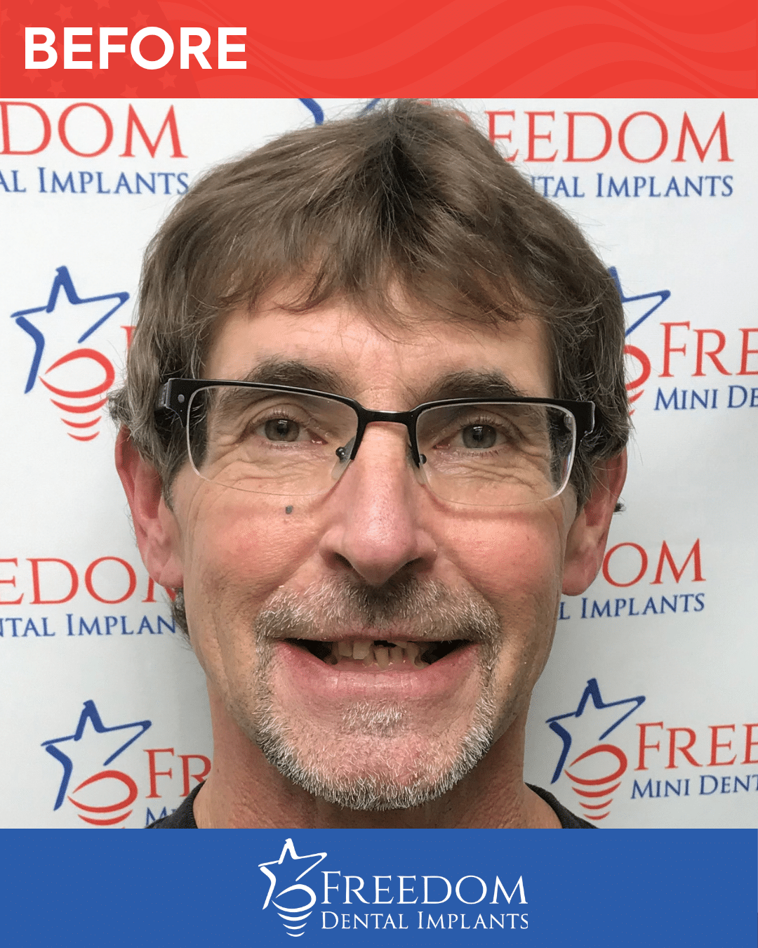 Before-treatment smile photo from Freedom Dental Implants in Louisville