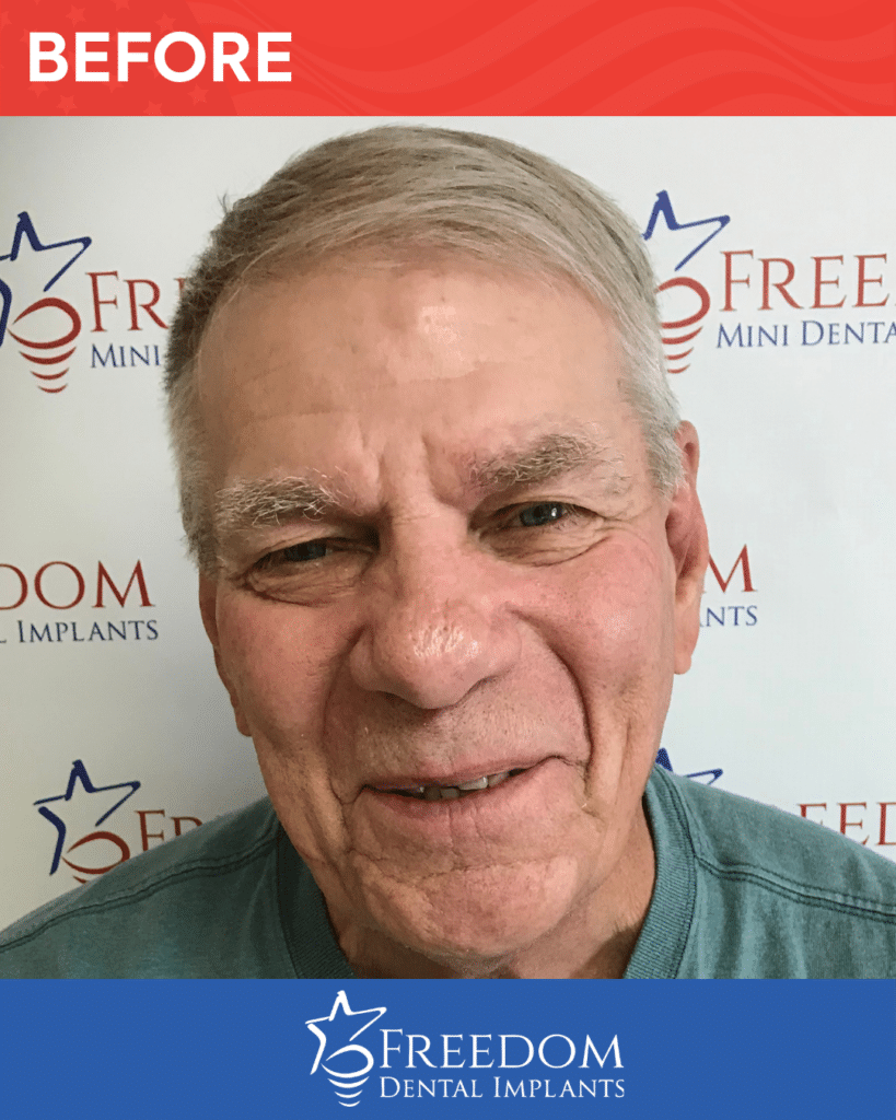 Before-treatment smile photo from Freedom Dental Implants in Louisville