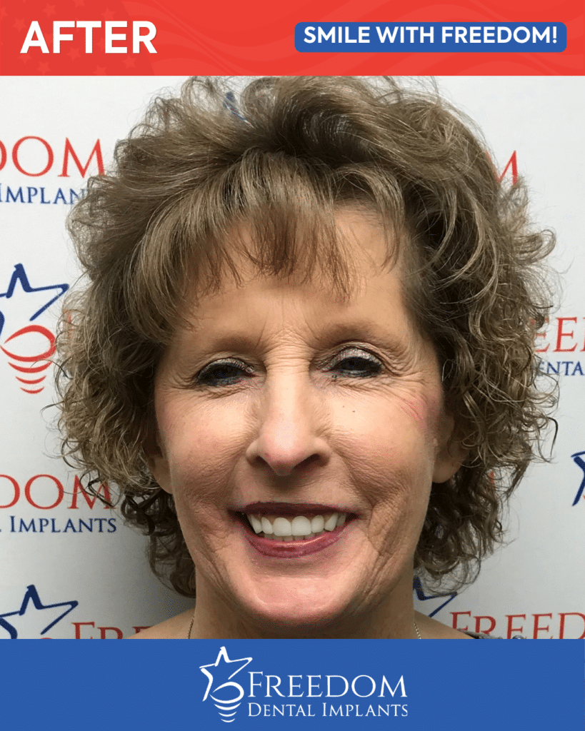 After-treatment smile photo from Freedom Dental Implants in Louisville