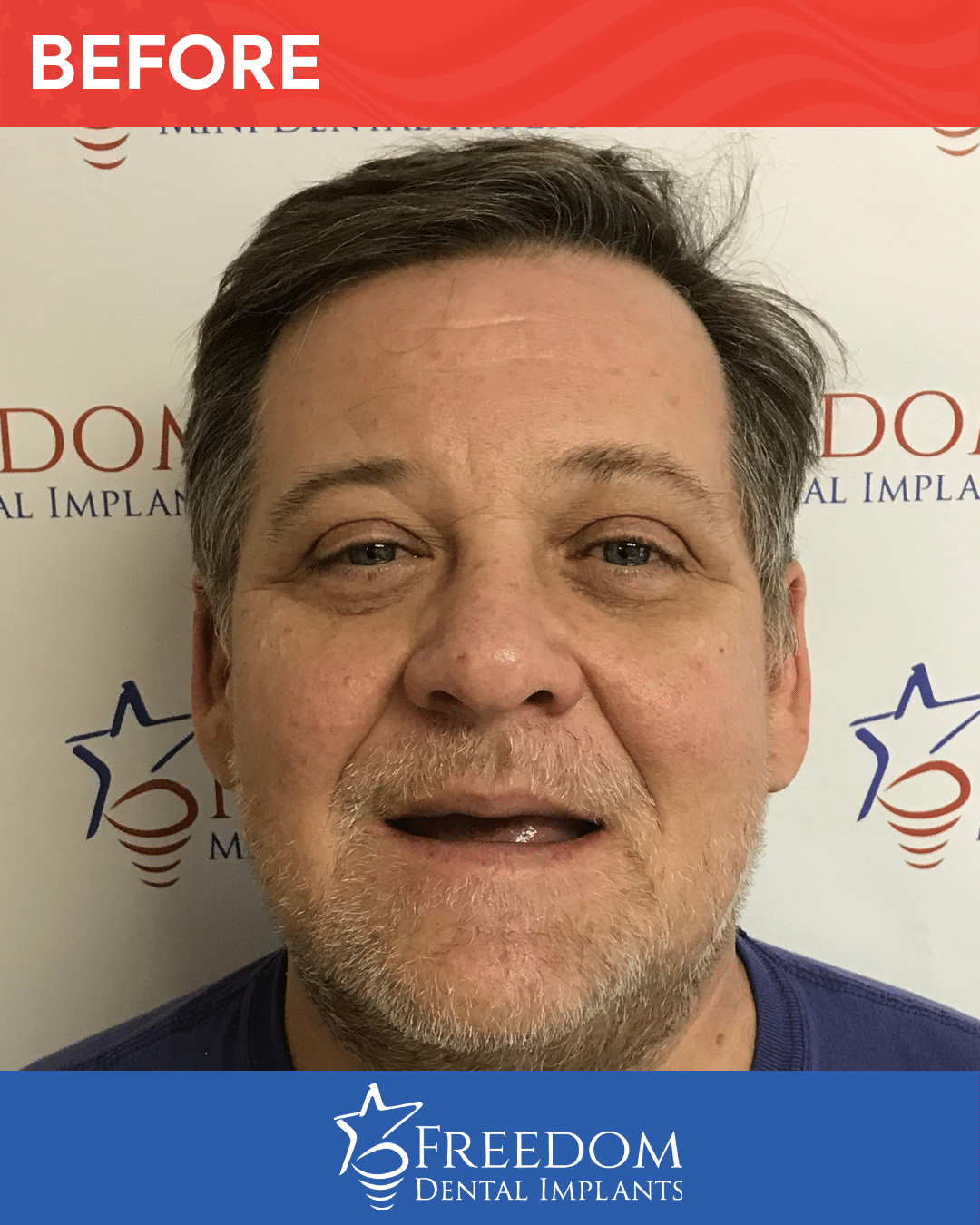 Before-treatment smile photo from Freedom Dental Implants in Louisville