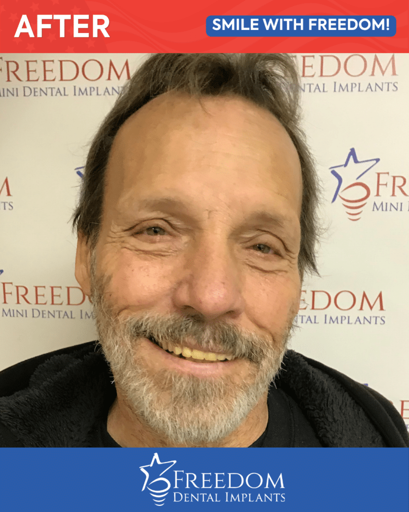 After-treatment smile photo from Freedom Dental Implants in Louisville
