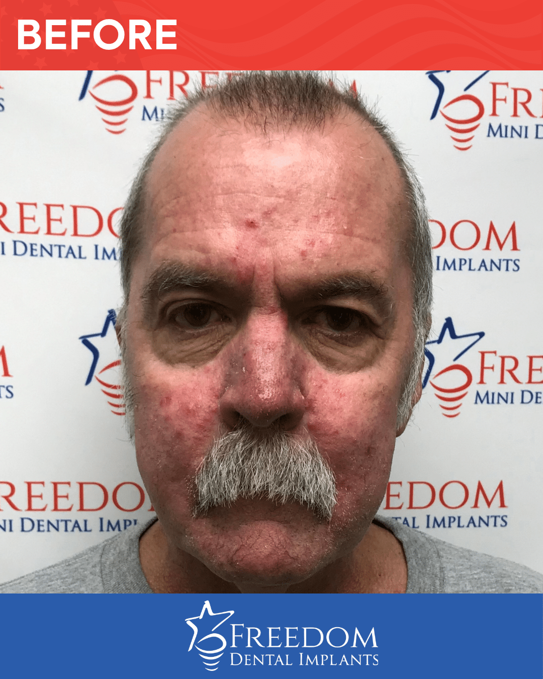 Before-treatment smile photo from Freedom Dental Implants in Louisville