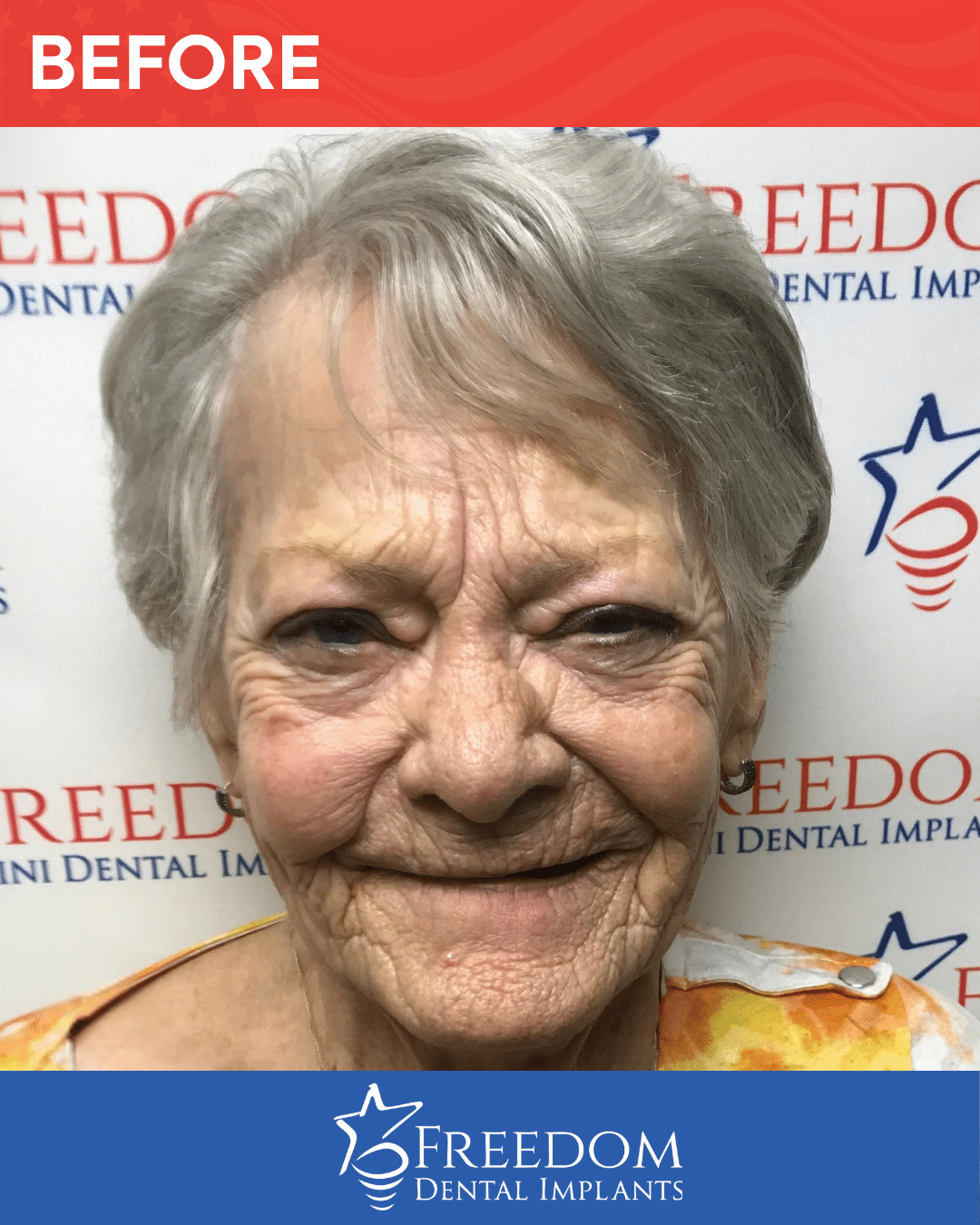 Before-treatment smile photo from Freedom Dental Implants in Louisville