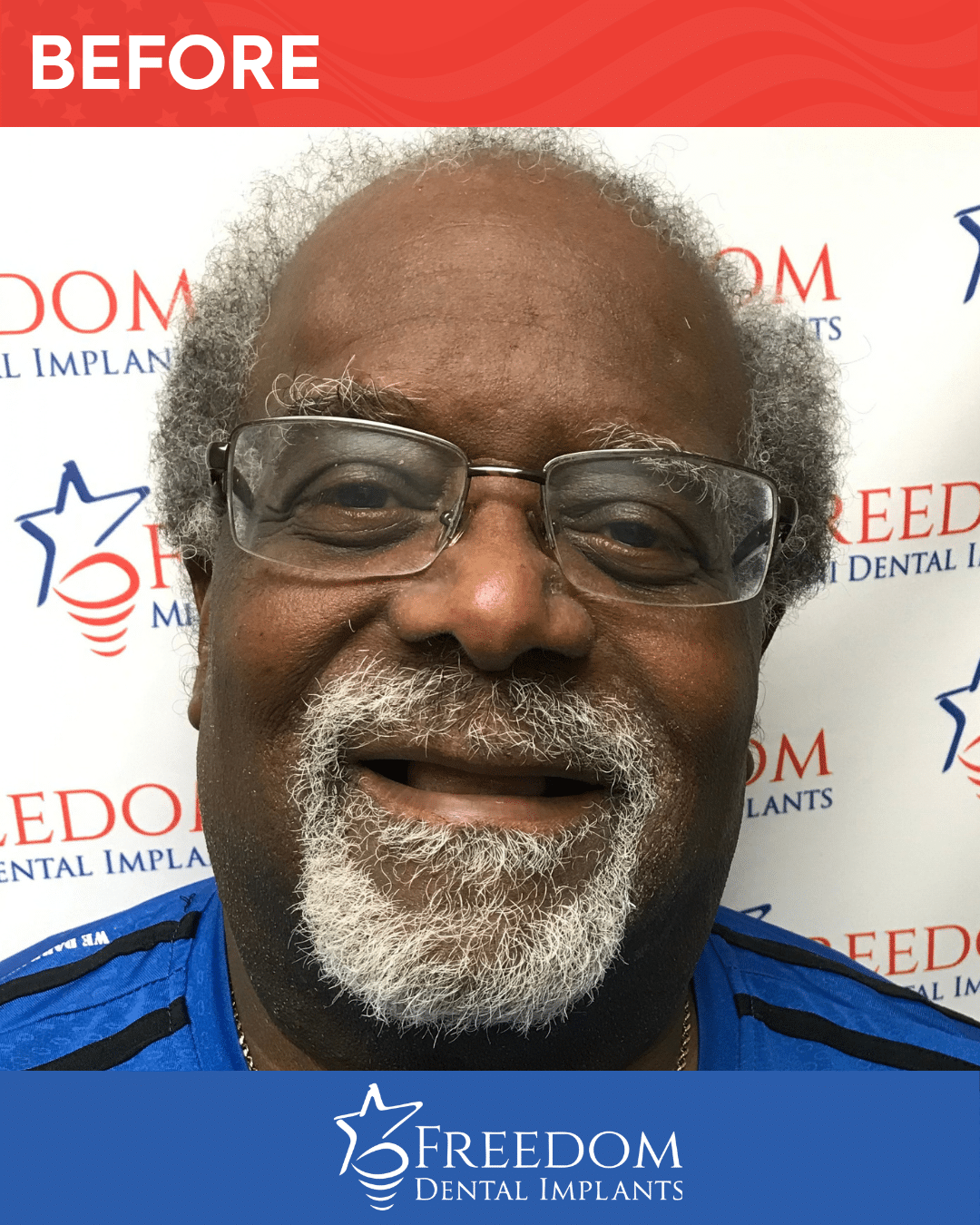 Before-treatment smile photo from Freedom Dental Implants in Louisville