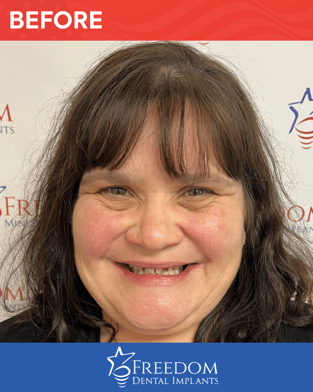 Before-treatment smile photo from Freedom Dental Implants in Louisville