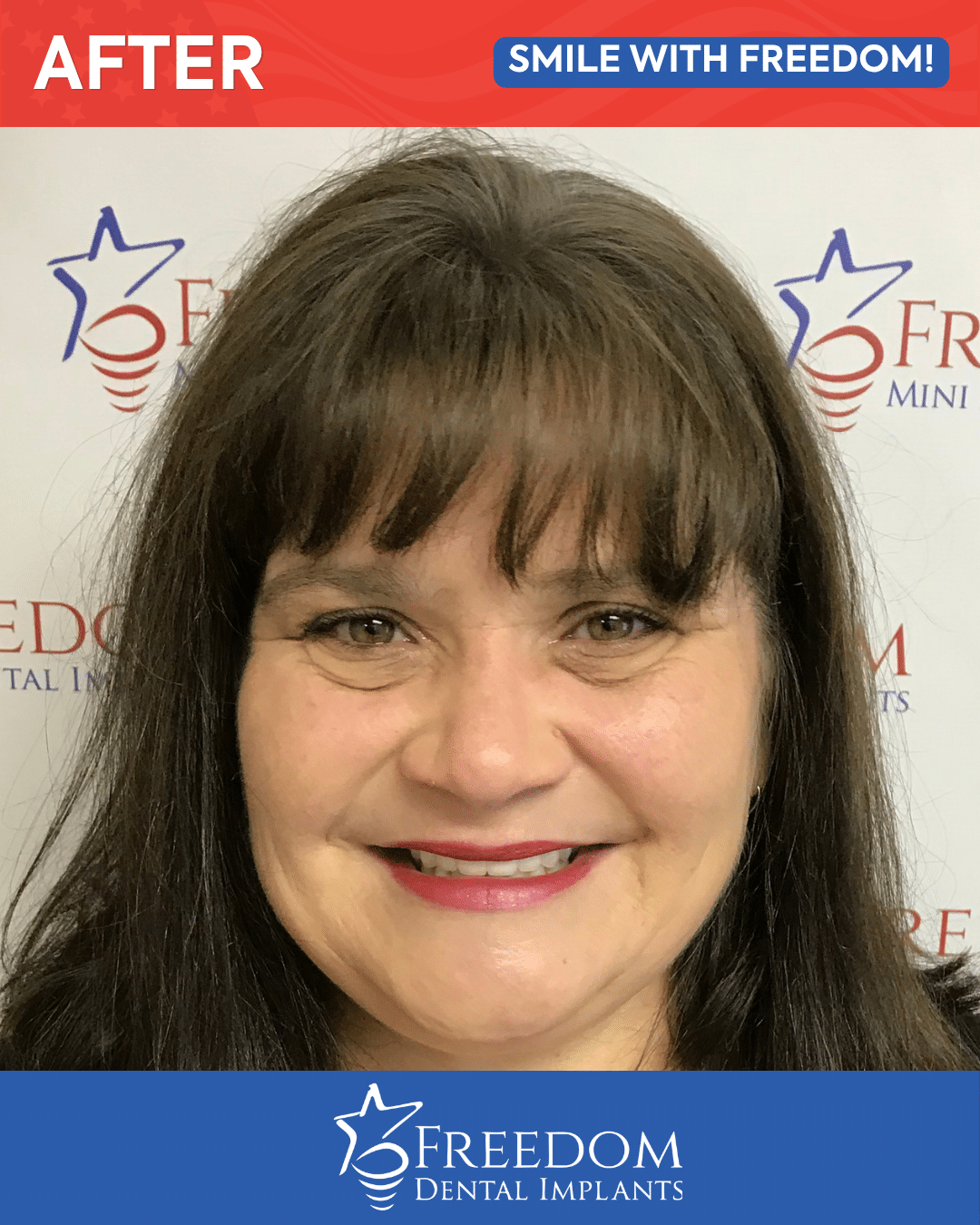 After-treatment smile photo from Freedom Dental Implants in Louisville