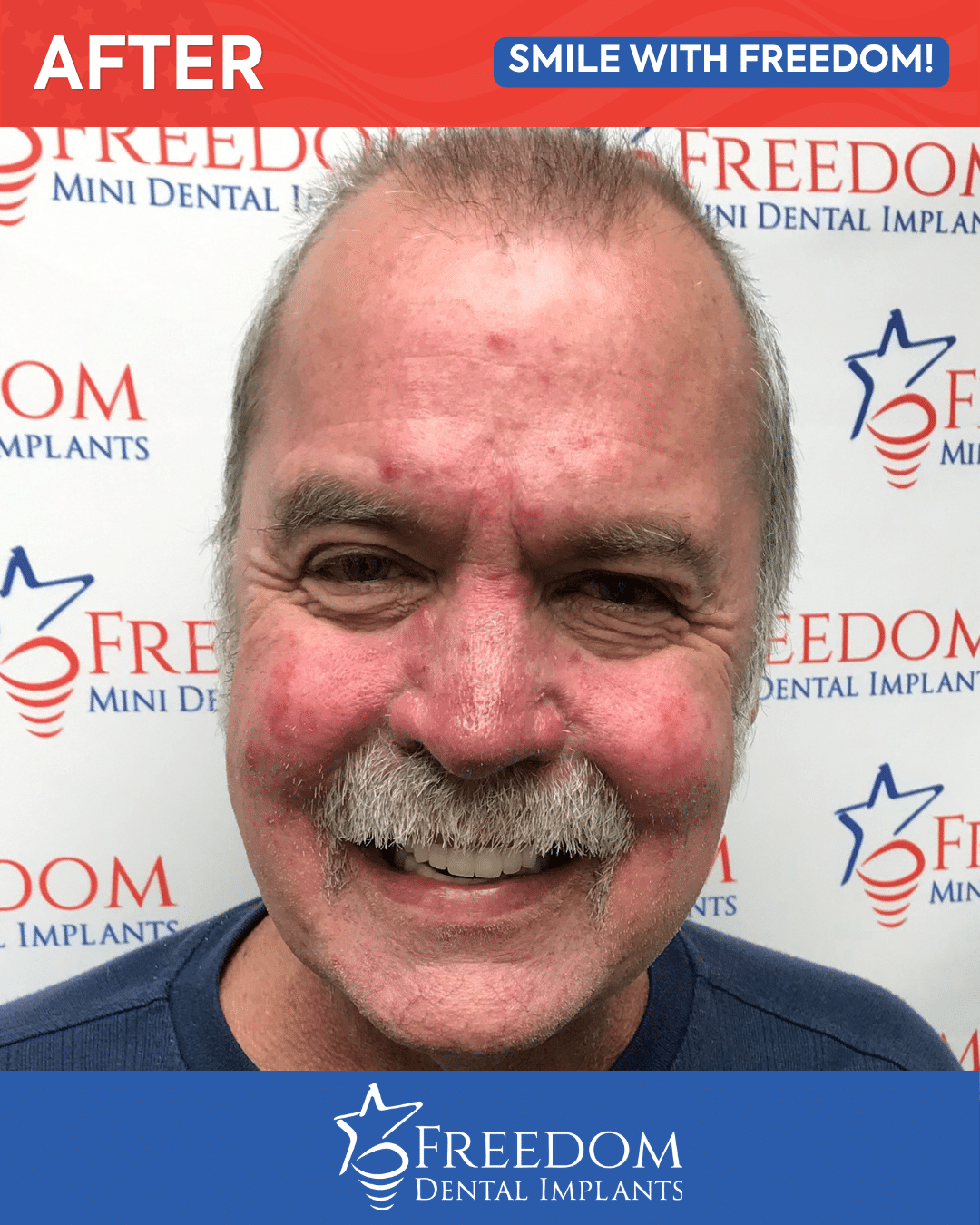 After-treatment smile photo from Freedom Dental Implants in Louisville