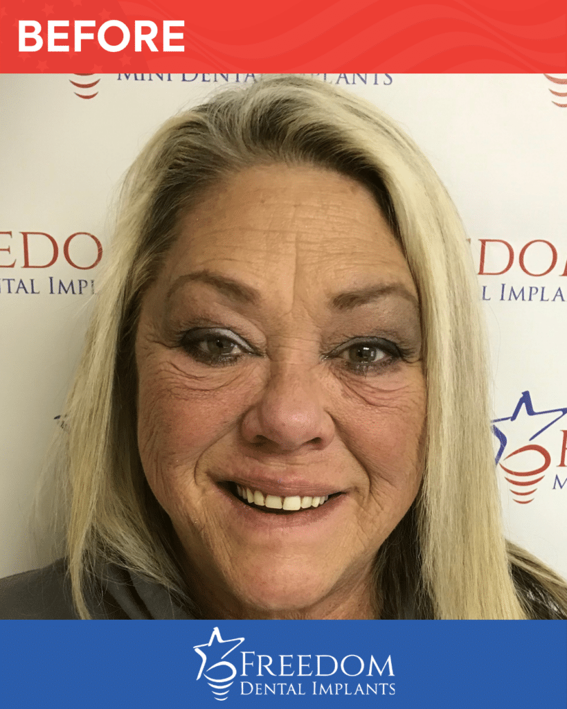 Before-treatment smile photo from Freedom Dental Implants in Louisville