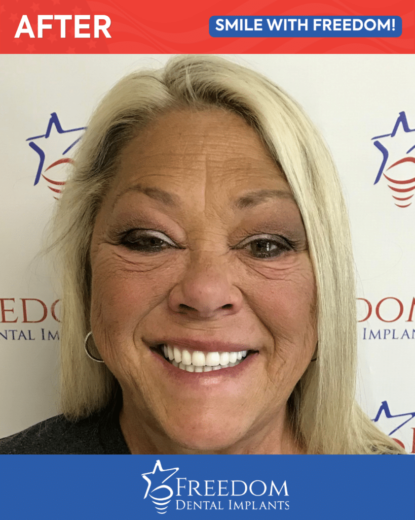 After-treatment smile photo from Freedom Dental Implants in Louisville