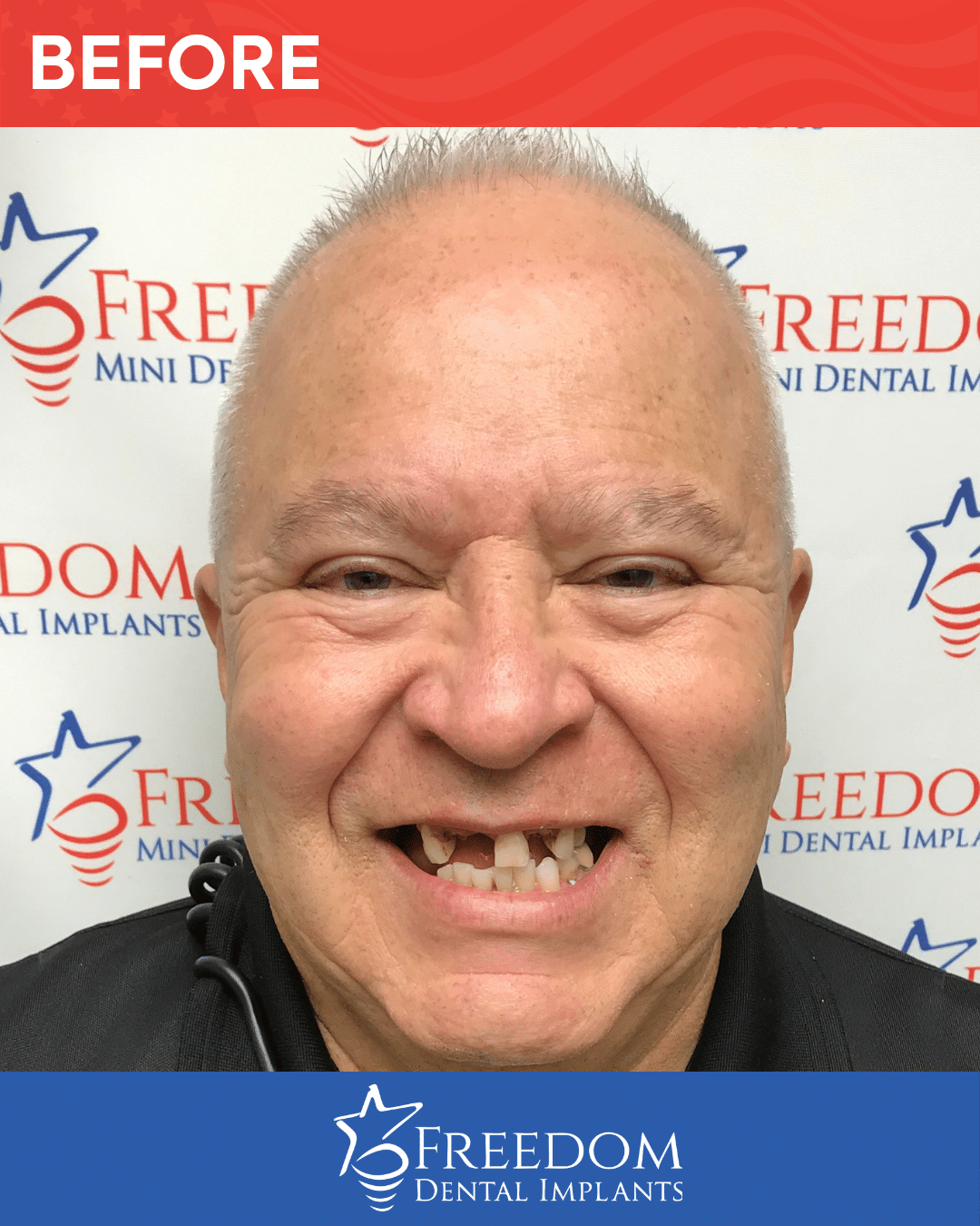 Before-treatment smile photo from Freedom Dental Implants in Louisville