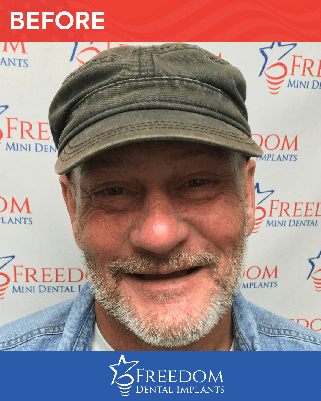 Before-treatment smile photo from Freedom Dental Implants in Louisville