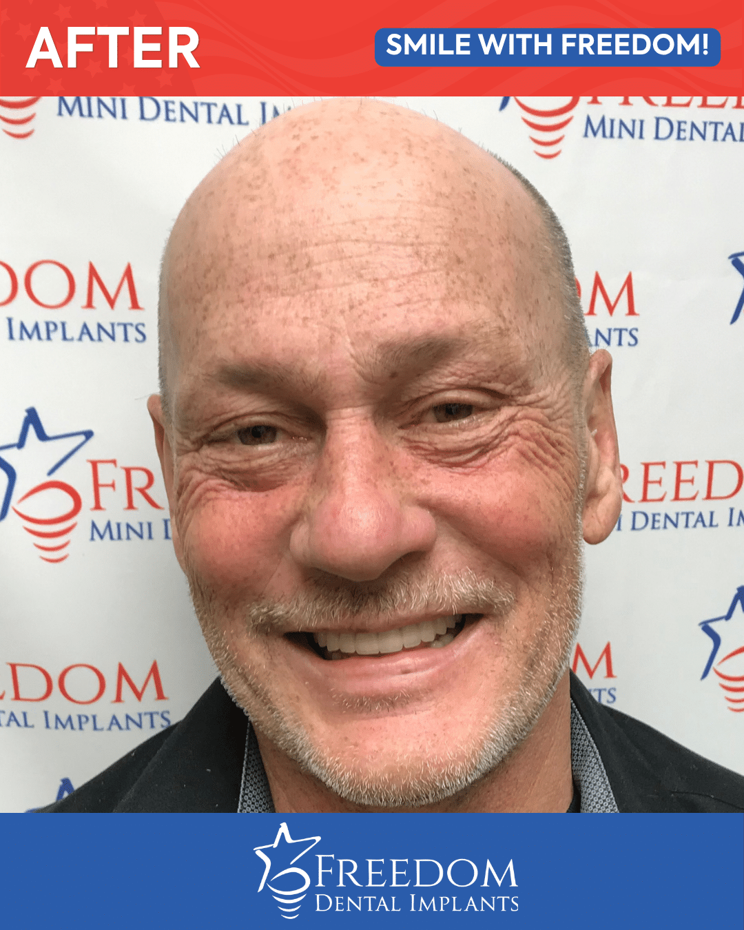 After-treatment smile photo from Freedom Dental Implants in Louisville