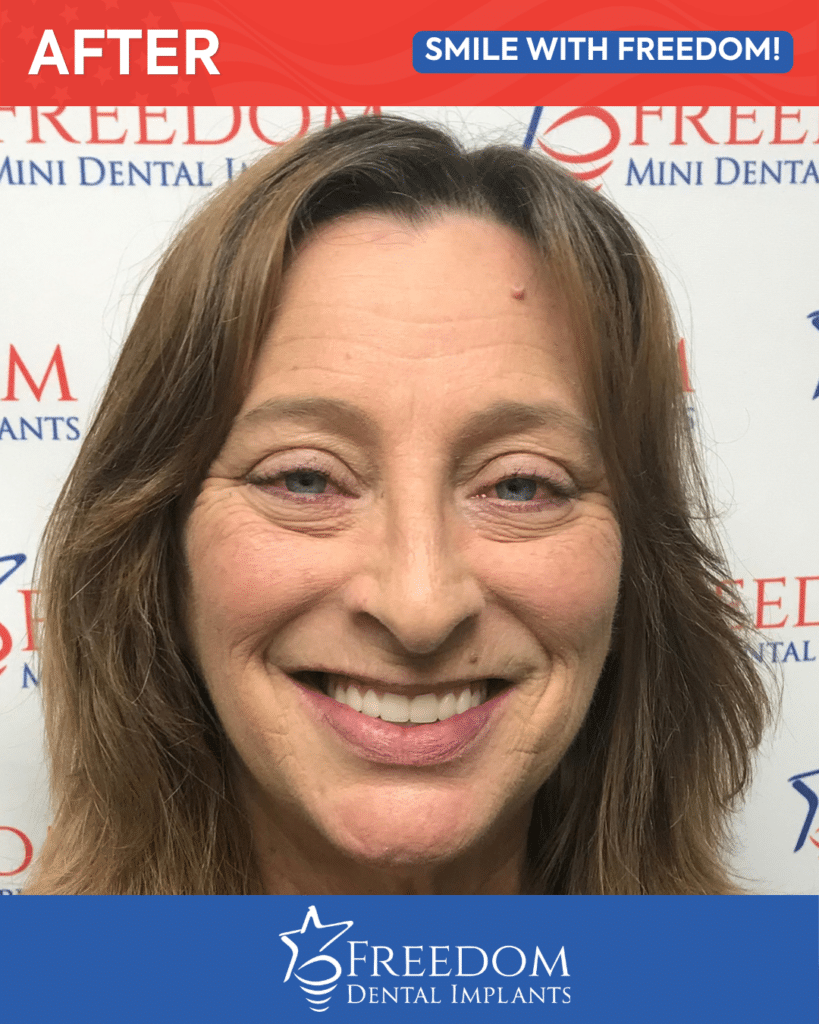 After-treatment smile photo from Freedom Dental Implants in Louisville