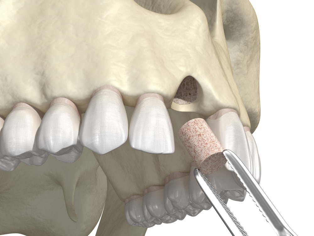 Bone Grafting in Louisville, KY.jpg