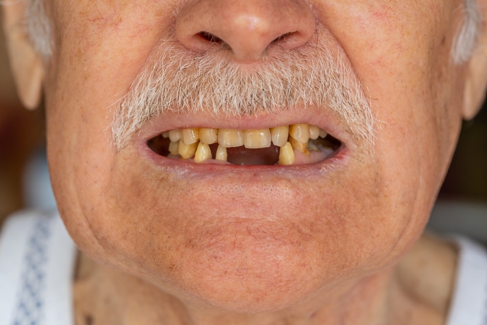 Detachable Implant Bridge