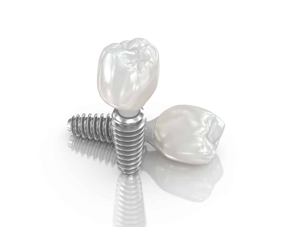 Mini Implant Crown