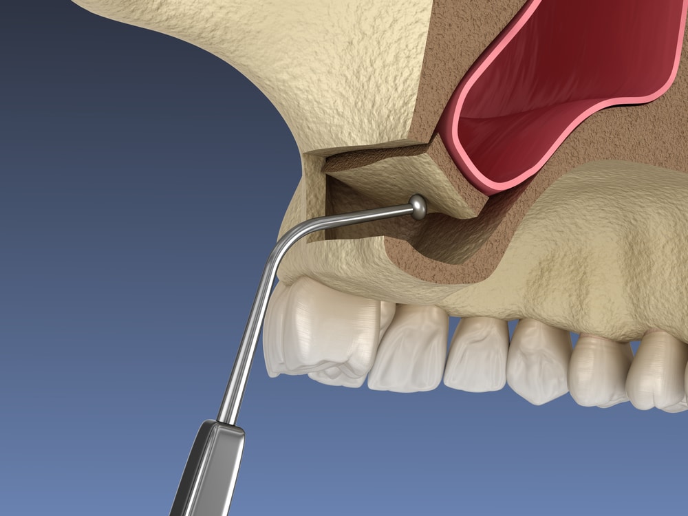 Sinus Lift Surgery in Louisville, KY