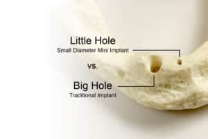 Traditional Implant Size vs. Mini Dental Implant Size | Free Consultations in Louisville, KY