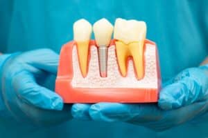 Dental model showing an implant-supported crown beside natural teeth