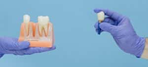 Dental model with a missing tooth space and a replacement implant
